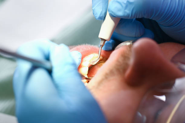 Best Emergency Dental Extractions in New Chicago, IN
